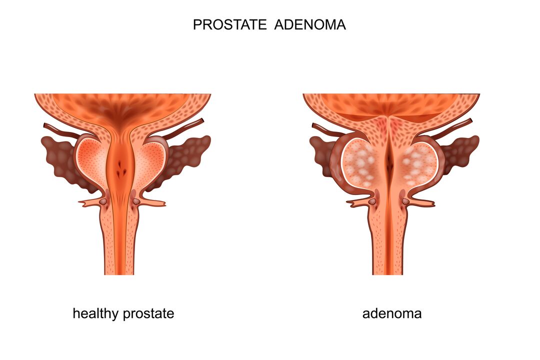 A healthy prostate and adenoma